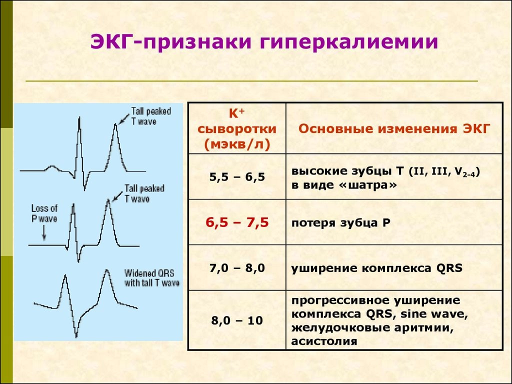 Экг признаки. ЭКГ критерии гиперкалиемии. Признаки гиперкалиемии на ЭКГ. Гипокалиемия и гиперкалиемия на ЭКГ. ЭКГ при гиперкалиемии.