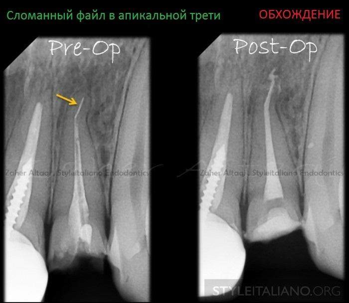 Апикальный перелом. Отлом эндодонтического инструмента в канале корня. Перелом инструмента в корневом канале зуба. Отломок инструмента в канале корня зуба. Отломок инструмента в корневом канале.