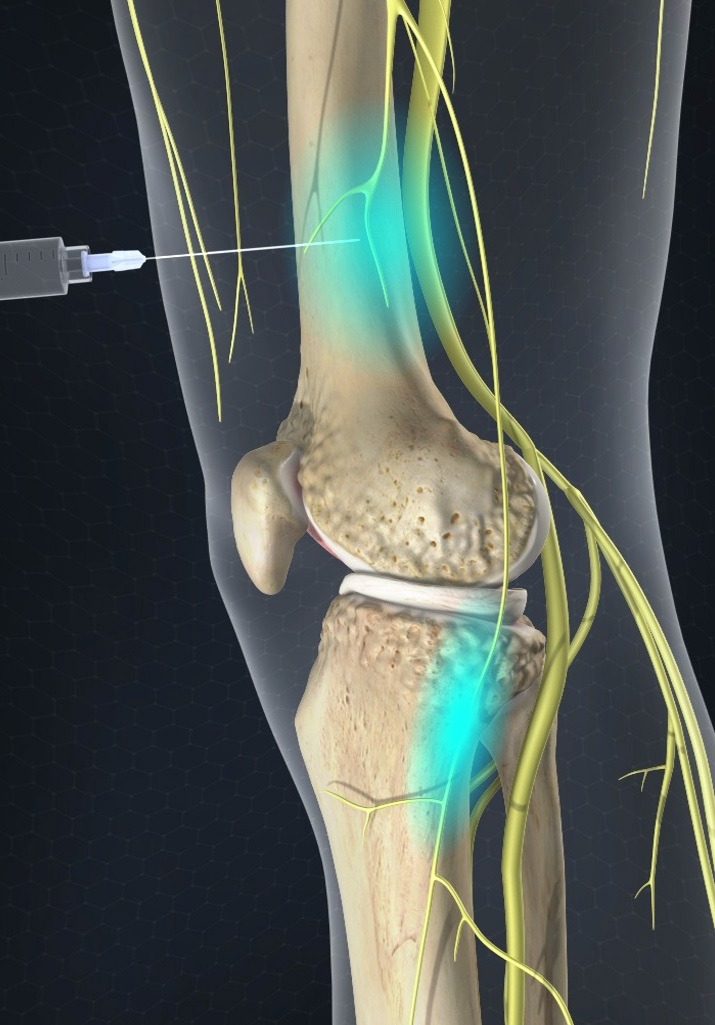 Травмы коленного сустава презентация. Нервы коленного сустава. Закрытые повреждения коленного сустава. Нерв на коленке. Повреждение нерва коленного сустава.