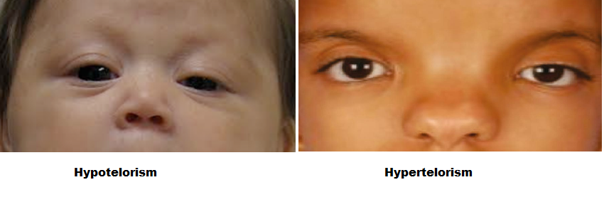 Orbital hipotelorizm de gözler birbirine çok yakın görünür. Kromozomal bozukuluklar, beyin anomalilerinde, mikrosefali de görülebilir.

Orbital hipertelorizm iki göz arasındaki mesafede anormal artış anlamına gelir. Kromozomal anomaliler, sendromik durumlarda görülebilir.