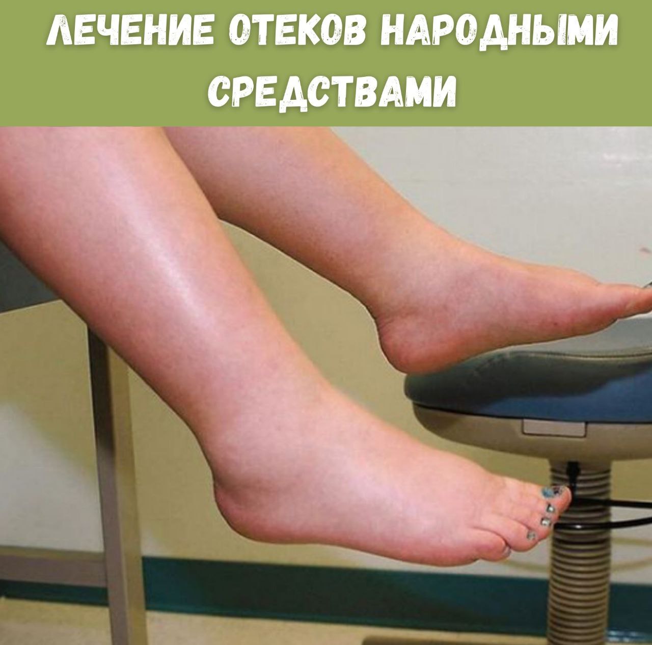 Лимфостаз Ног Картинки — Mixyfotos.ru
