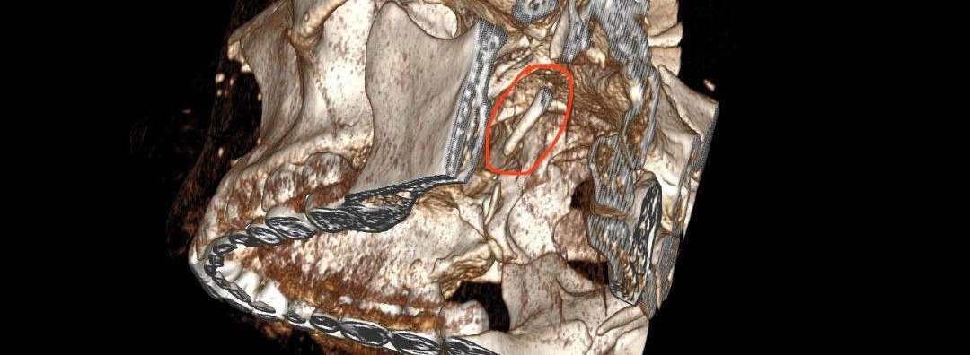 Хабаровские хирурги удалили кость из ротоглотки пациентки