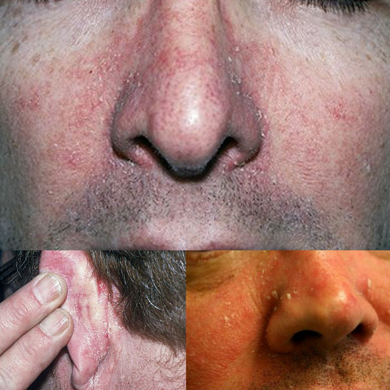 Ekcéma seborrheic dermatitis pikkelysömör | Sanidex Magyarországon