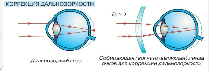 Линза 2 дптр. Может ли из-за линз ухудшится зрение. Ухудшилось зрение после перенашивания линз.