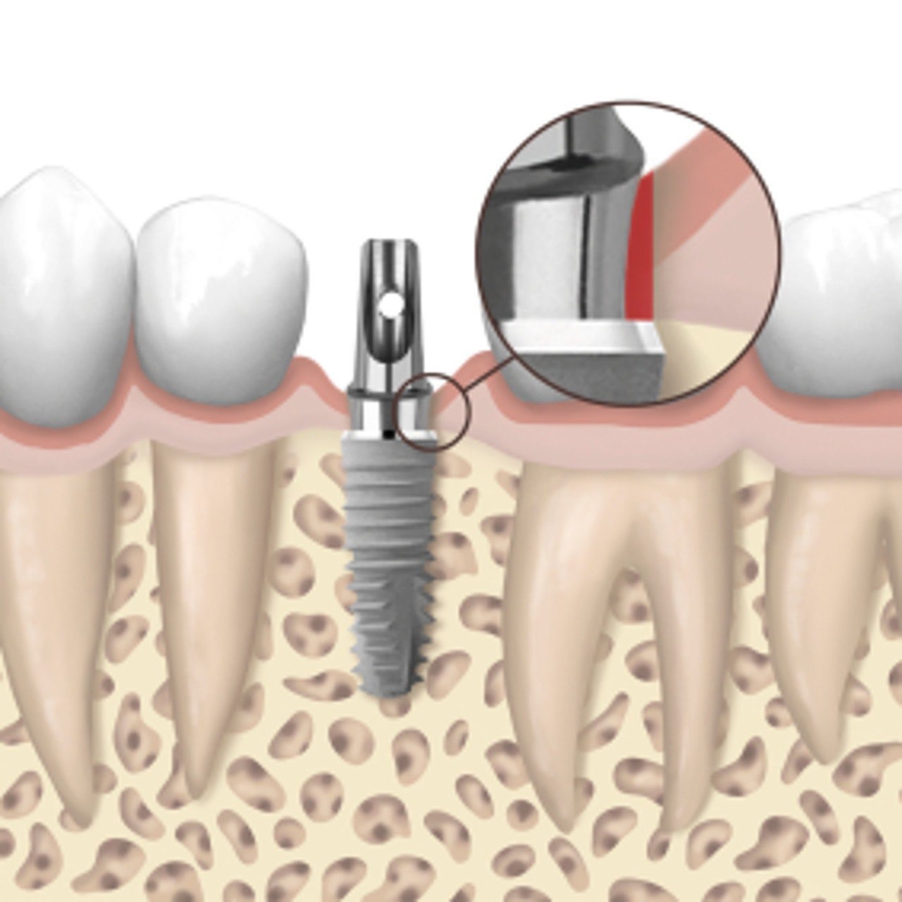 Зубной имплант XIVE