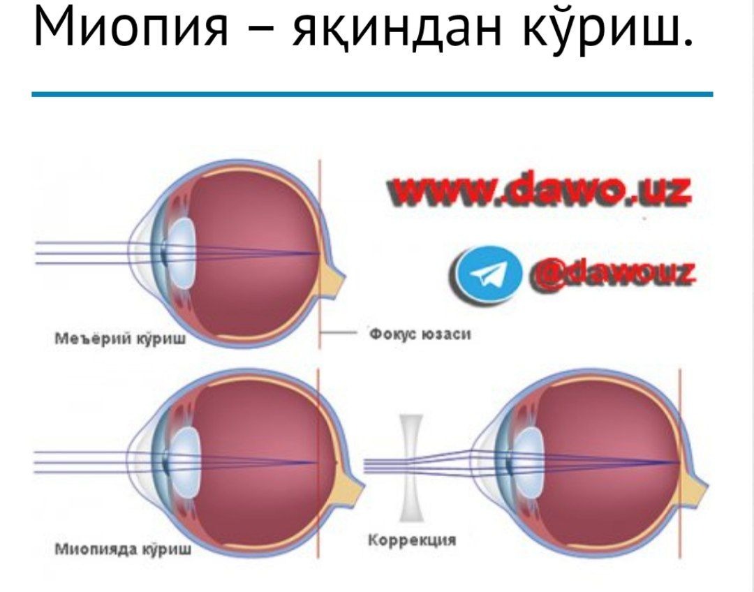 Миопия 1 степени что это у ребенка. Группа здоровья по миопии. Миопия 2 степени при беременности.