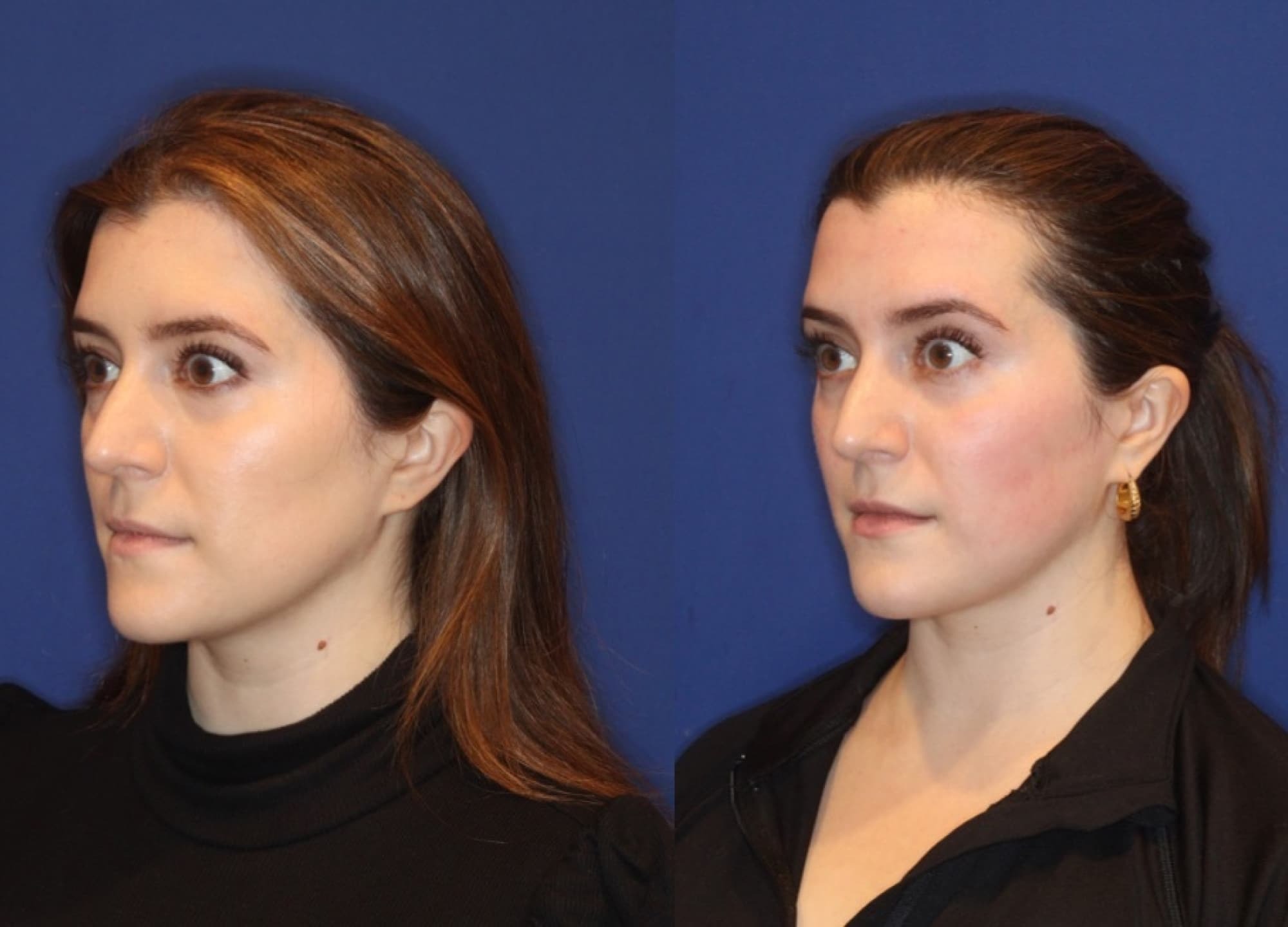 EMFACE IN DUBAI PROVIDES A FACELIFT WITHOUT NEEDLES Telegraph