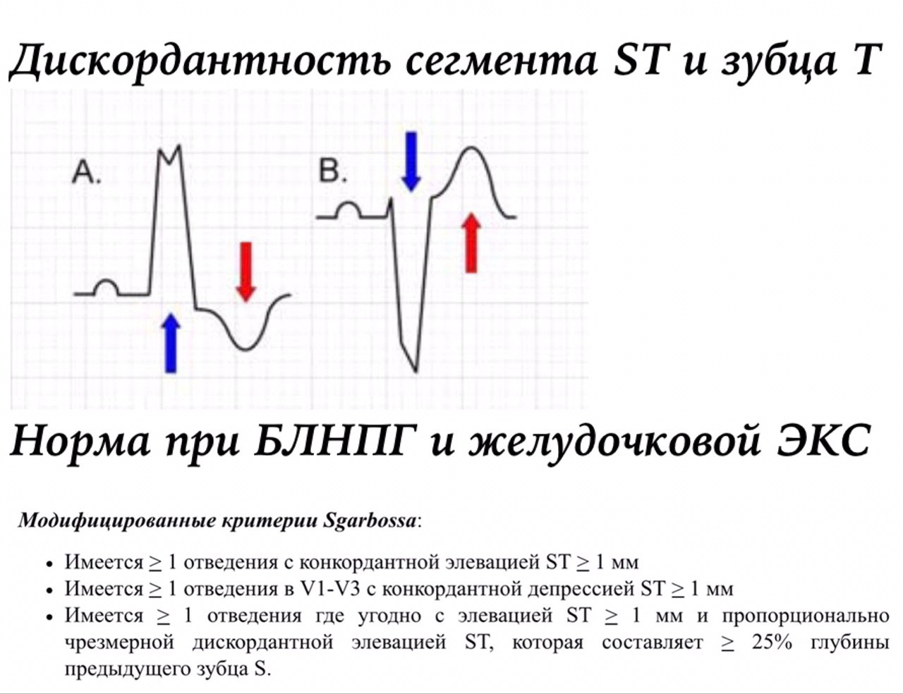 Блокада левой ножки пучка гиса экг