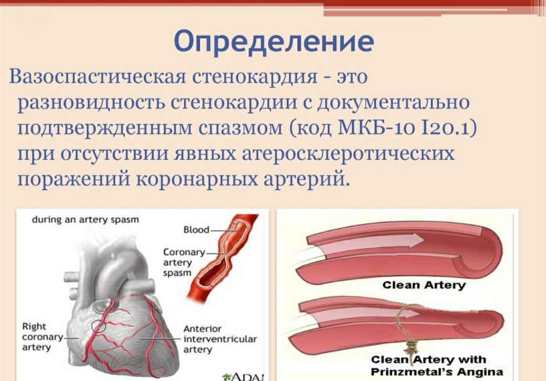 Атеросклероз аорты и коронарных артерий. Стенокардия Принцметала патогенез. Вазоспастическая стенокардия этиология. Спазм коронарных артерий. Вазоспастическая стенокардия формулировка диагноза.