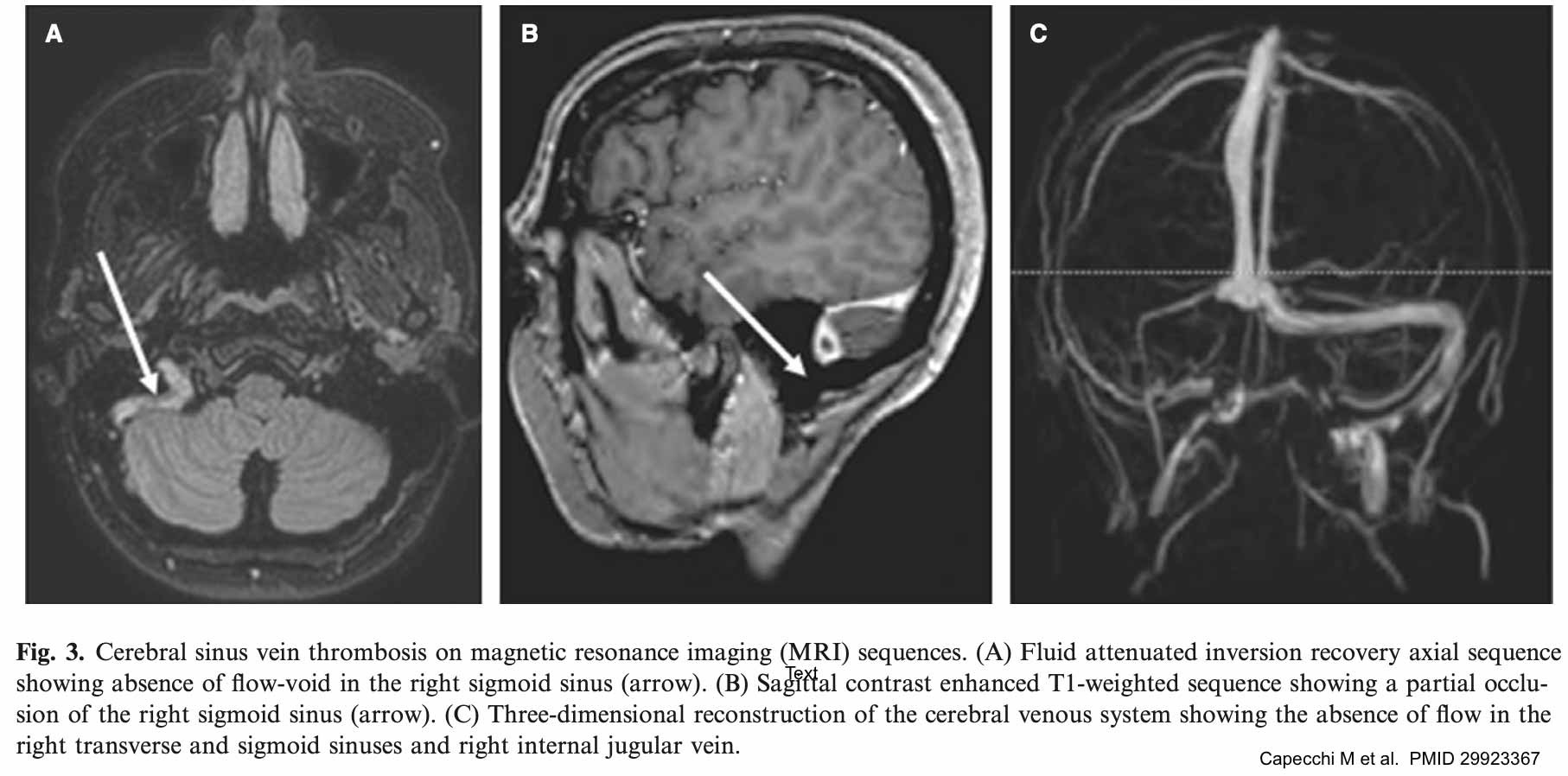 Тромбоз венозных синусов головного мозга – Telegraph