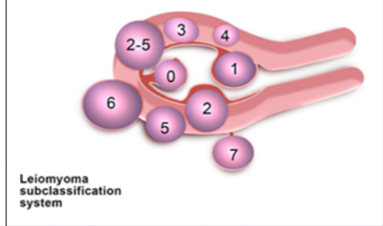 Типы миом. Фиго миома классификация. Классификация по Фиго миомы матки. Классификация миомы матки по Figo 2020. Типы миоматозных узлов по УЗИ.