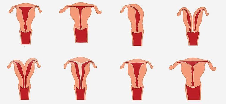 Две матки. Врожденные аномалии матки. Патологии строения матки. Аномалии развития матки и влагалища. Аномалии матки у женщин.