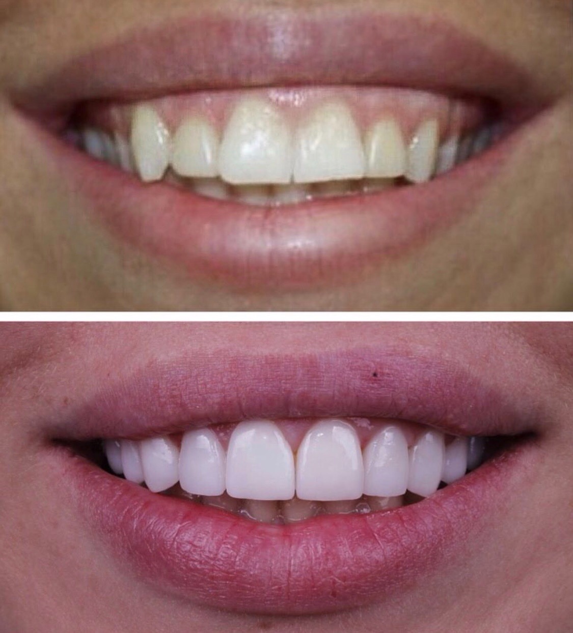 Виниры: вопросы и ответы?