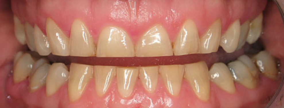 Что такое атриция, абразия, абфракция, эрозия? – Telegraph