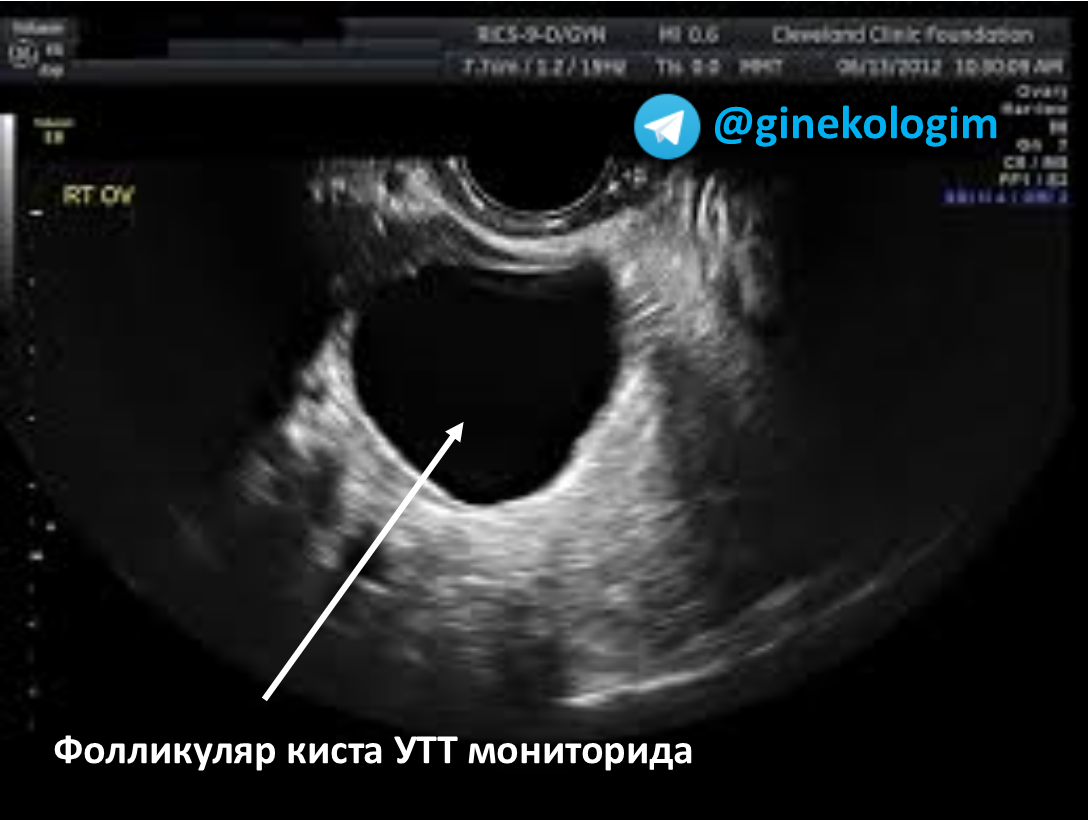 Как выглядят фолликулы на УЗИ. 5. На месте лопнувшего фолликула образуется …. Фолликула етишмовчилиги сабаблари.