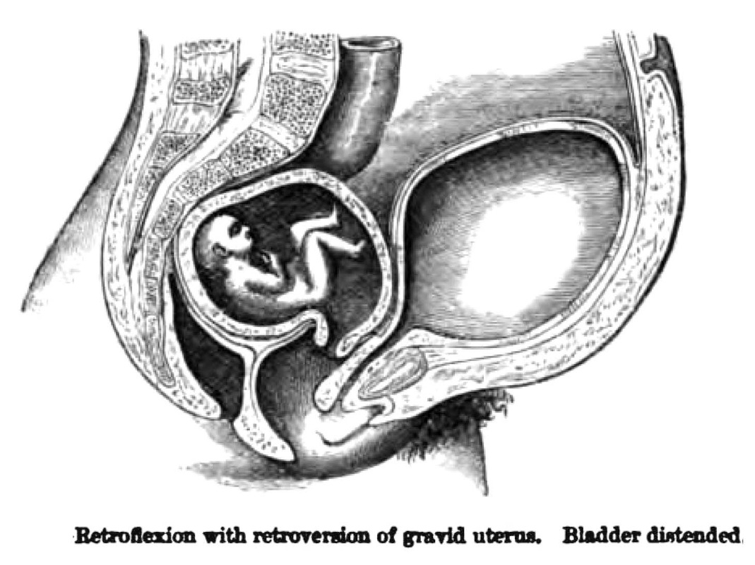 retrovert uterus gebelikleri bir nevi hipoksi altında giden gebeliklerdir ayrıca bu uteruslarda  torsiyon riskide nadir olsa da vardır.