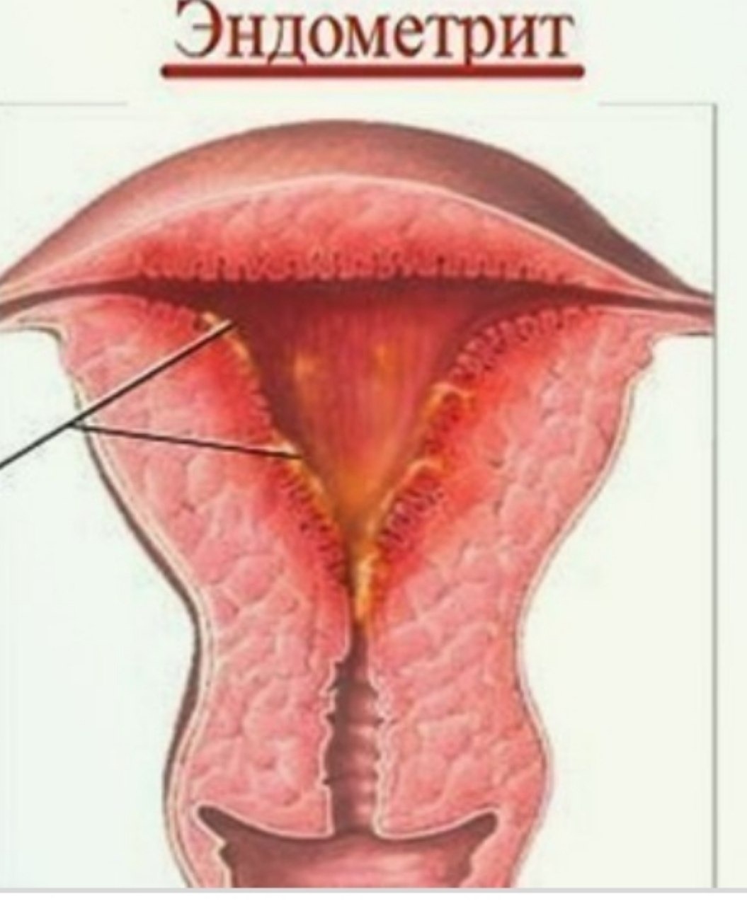 Эндометрит. Бачадон тузилиши. Эндометрит макро и микро.