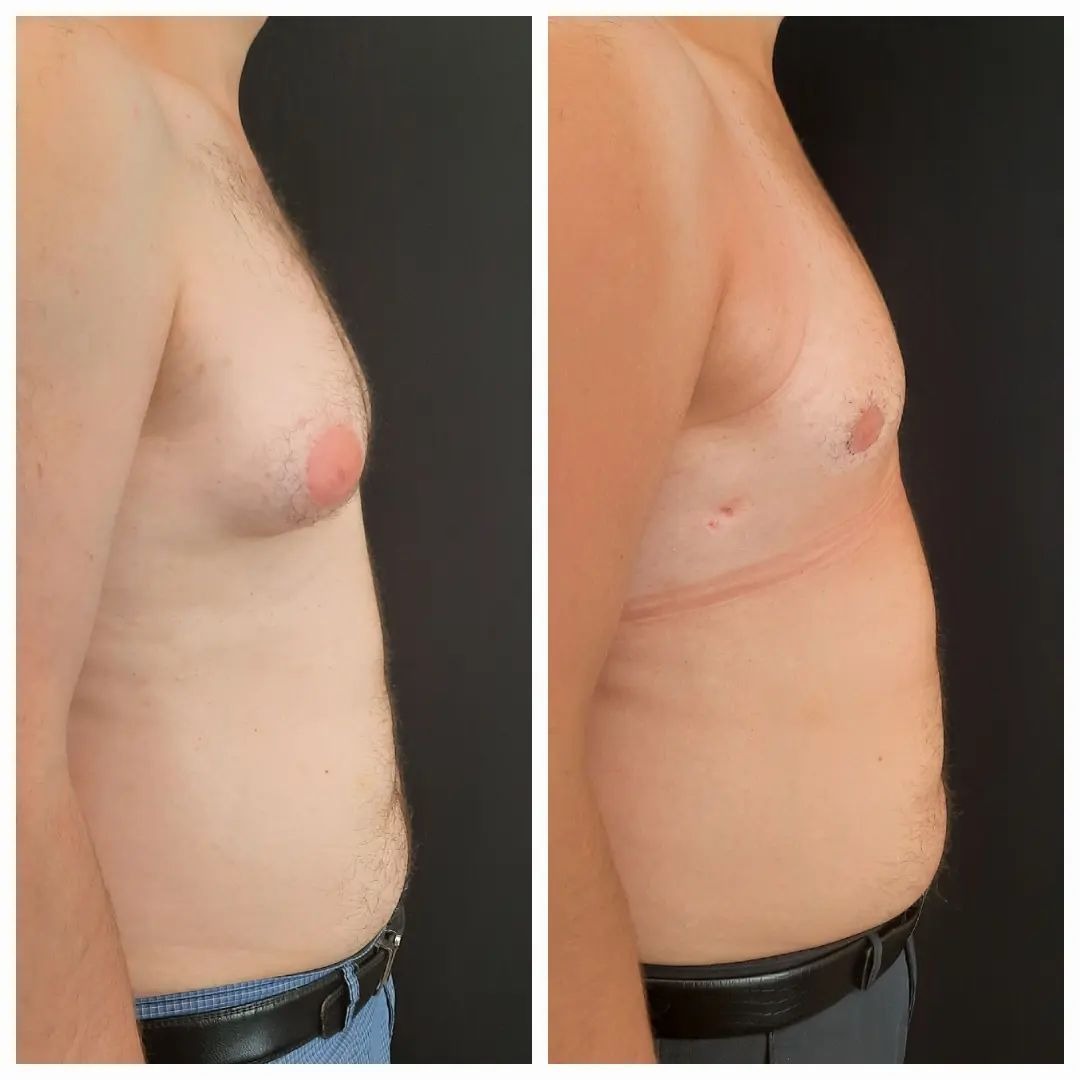 асимметрия груди у мужчин фото 5