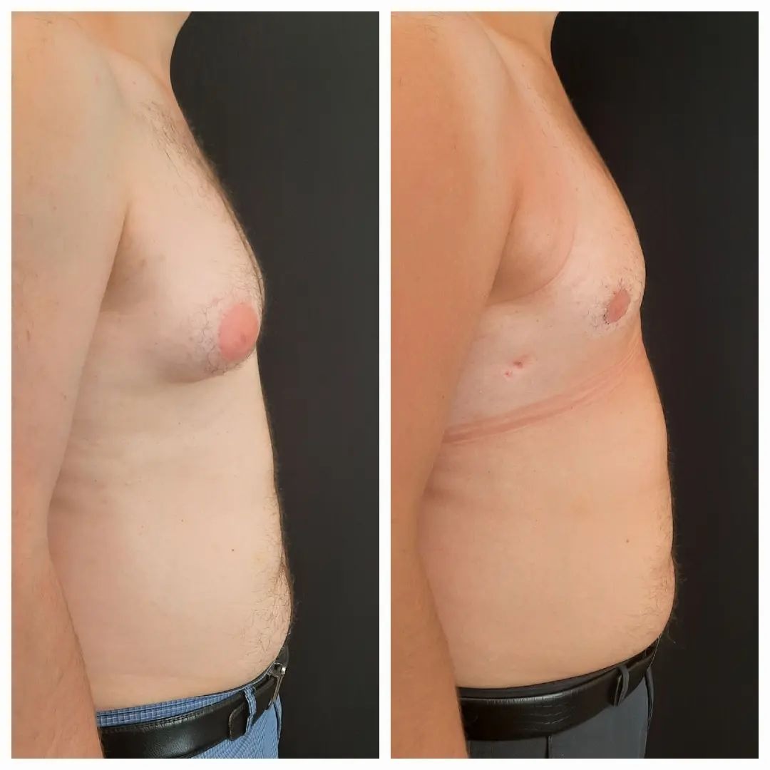 Gynecomastia airsculpt