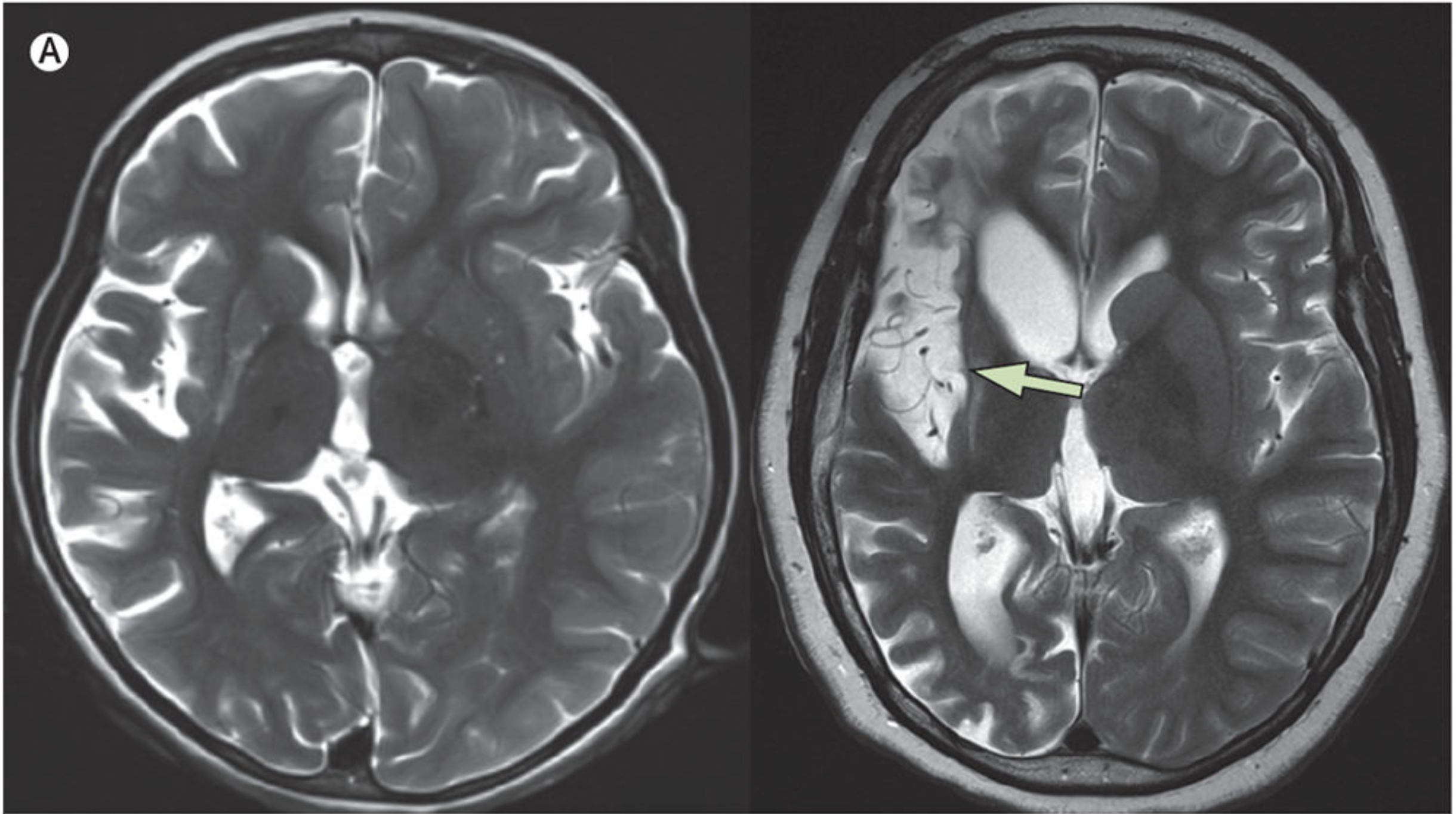 Аутоиммунный энцефалит расмуссена. Rasmussen encephalitis MRI. Энцефалит Расмуссена мрт. Синдром Расмуссена мрт.