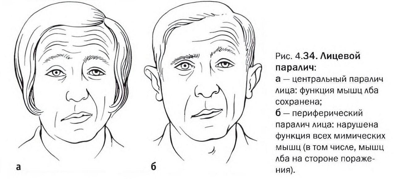 Инсульт паралич левой. Центральный парез лицевого нерва при инсульте. Периферический парез лицевого нерва. Центральный и периферический парез лицевого нерва.