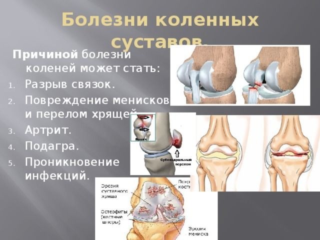 Массаж при артрозе коленного сустава