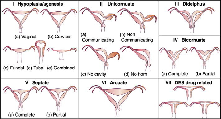 Kürtaj, uterus anomalileri (rahim anomalileri) olan kadınlarda dikkatli şekilde planlanmalı, uygulanmalıdır. Uterus anomalileri, rahmin doğuştan veya sonradan gelişen yapısal değişiklikleridir. Anomaliler arasında septat uterus, bikornuat uterus, bicornis bicollis uterus, tek boynuzlu uterus gibi çeşitli tipler bulunur.

Muğla kürtaj işlemi, uterusun anatomik yapısını dikkate alarak uygulanmalıdır. Anormal uterus şekli, işlemi gerçekleştirecek doktorun yaklaşımını etkileyebilir. Örneğin, septat uterus durumunda, septumun çıkarılması , bölünmesi gerekebilir. Bikornuat uterus durumunda, her uterin kaviteye ayrı ayrı müdahale edilmesi gerekebilir.

Uterus anomalileri, kürtaj işlemi sırasında ekstra dikkat gerektirebilir. Doktor, önceden yapılacak ultrason veya diğer görüntüleme yöntemleriyle uterusun anatomik yapısını değerlendirecek, uygun planlama yapacaktır. İşlem sırasında, özel cerrahi aletler , rehberlik teknikleri kullanılabilir.

Kürtaj sonrasında iyileşme süreci önemlidir. Uterus anomalileri olan kadınlar, doktorun verdiği talimatlara dikkatlice uymalı iyileşme sürecini yönetmelidir. İşlem sonrası olası komplikasyonlar, kanama, enfeksiyon , rahatsızlık gibi belirtiler ortaya çıkarsa, doktora başvurulmalıdır.

Uterus anomalileri, kürtaj işlemini etkileyebilecek faktörlerdir. Anomali varlığını doktorunuzla paylaşmak onun önerilerine uyum sağlamak önemlidir. Doktor, uterus anomalilerine, bireysel duruma göre en uygun yaklaşımı belirleyecek, işlemi güvenli şekilde gerçekleştirecektir.