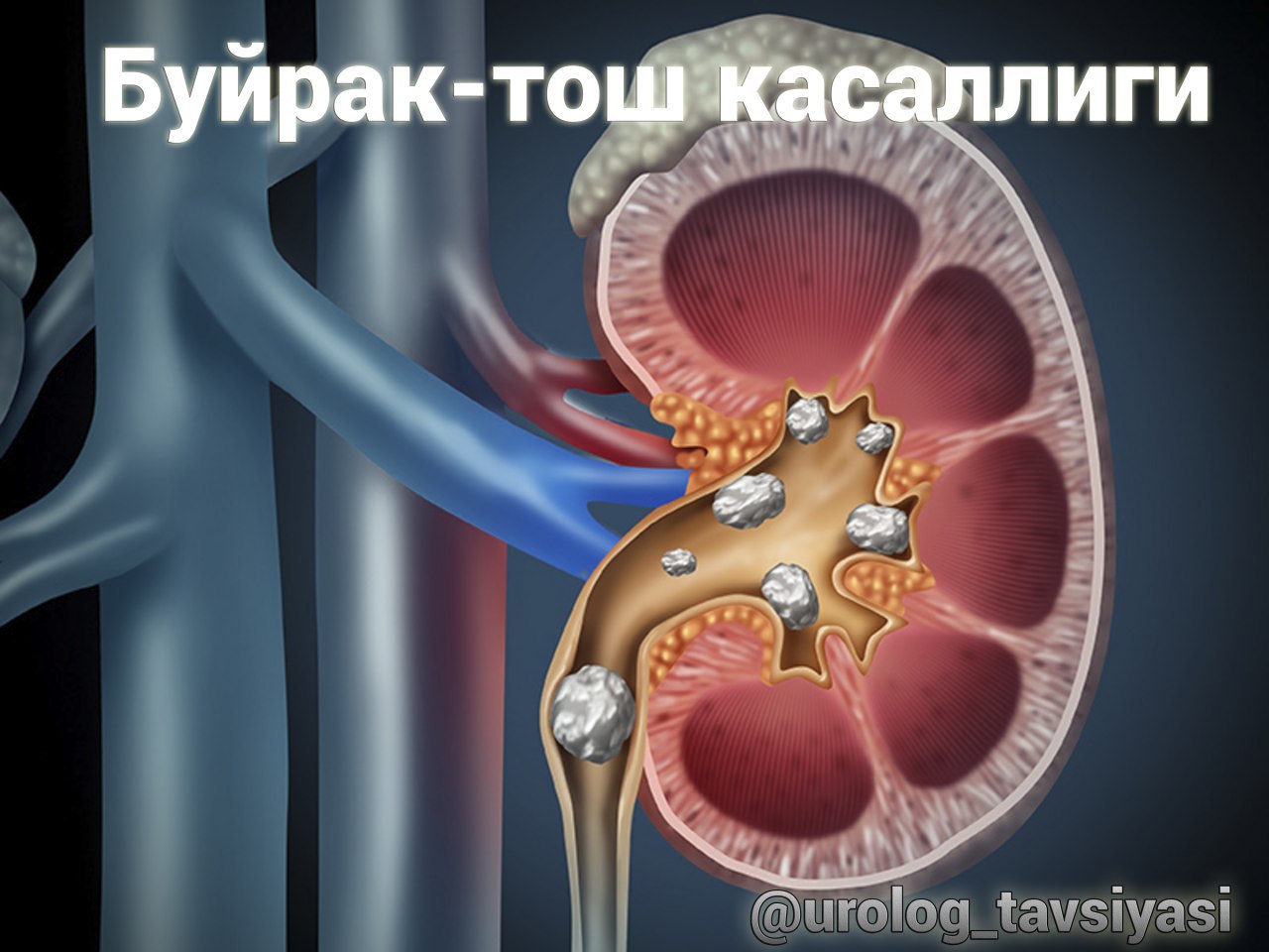 Воспаление почек камни в почках