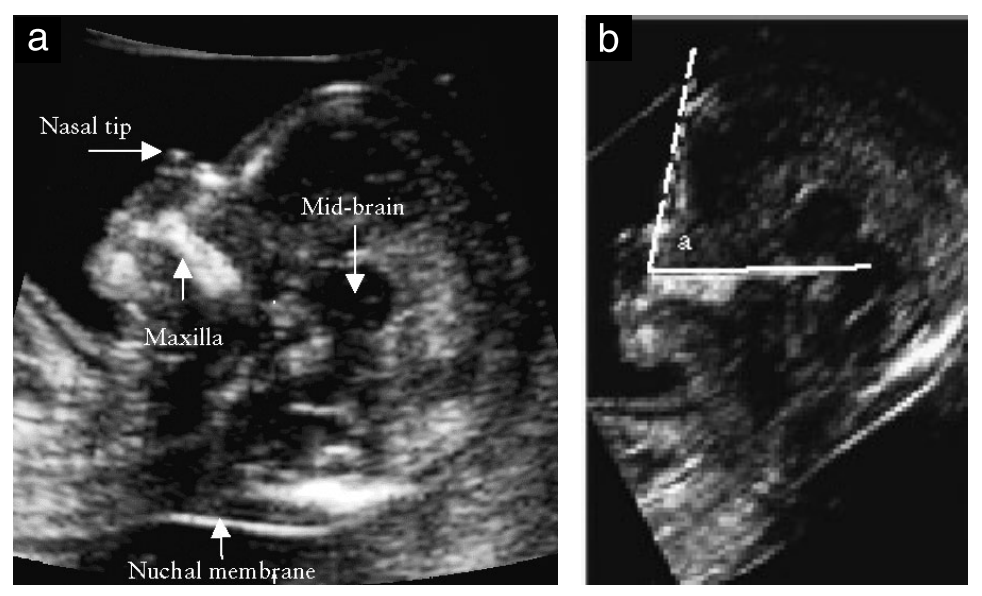 Trizomili fetuslarda görülen burun kökündeki basıklığın ultrasonla fetal peryotta değerlendirilmesidir