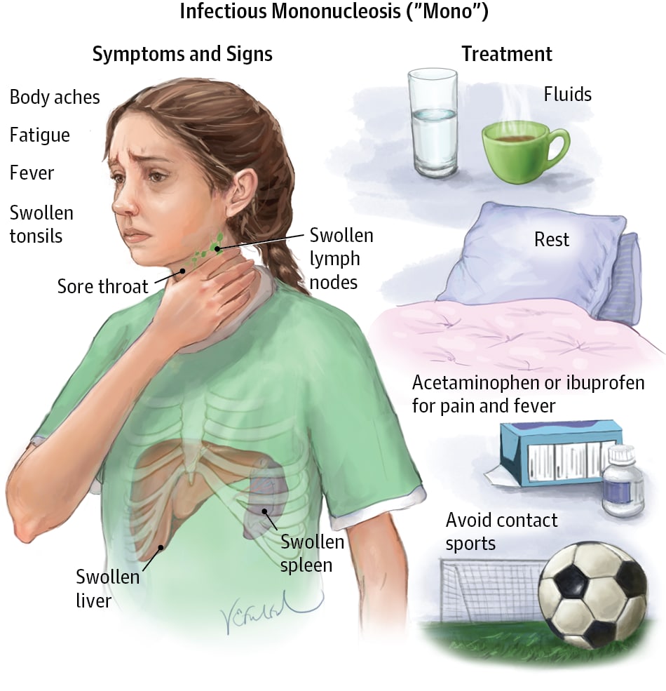 Боль в горле болит голова. Инфекционный мононуклеоз (инфекция вирусом Эпштейна — Барра). Основные симптомы инфекционного мононуклеоза. Инфекционный мононуклеоз у детей симптомы.