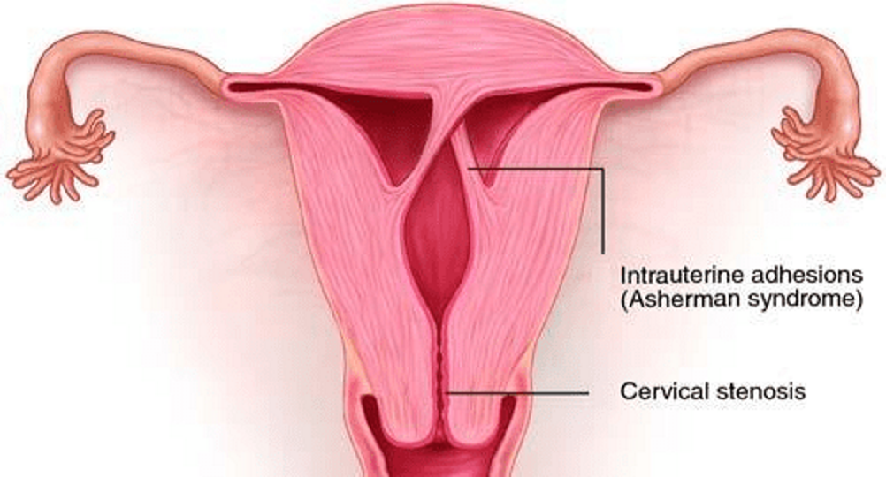 Kürtaj işlemi, nadiren de olsa, rahim içerisinde yapışıklık (uterin adezyon) oluşmasına neden olabilir. Rahim içerisindeki yapışıklıklar, rahim boşluğunu daraltabilir veya bloke edebilir. İlerideki gebeliklerde sorunlara yol açabilir. İşte kürtaj sonrası rahim içerisinde yapışıklık oluşması hakkında bilinmesi gereken bazı noktalar:

1. Yapışıklık Oluşumu Nedenleri:
- Yapışıklıklar, rahim içerisindeki dokuların iyileşme sürecinde yanlış şekilde birleşmesi - yapışması sonucunda oluşabilir.
- Kürtaj işlemi sırasında rahim içerisindeki dokuların tahriş olması, yara yüzeylerinin birbirine yapışması yapışıklık oluşumunu tetikleyebilir.

2. Yapışıklığın Etkileri:
- Rahim içerisinde yapışıklık oluşması, ilerideki gebeliklerde sorunlara yol açabilir.
- Yapışıklıklar, rahim boşluğunu daraltabilir, tıkar, gebeliğin rahme yerleşmesini, normal şekilde gelişmesini engelleyebilir.
- Yapışıklıklar ayrıca adet düzensizlikleri, ağrılı adet dönemleri, tekrarlayan düşüklere yol açabilir.

3. Tedavi - Yönetim:
- Kürtaj sonrasında yapışıklık oluşumu durumunda, tedavi genellikle histeroskopi adı verilen prosedürle gerçekleştirilir.
- Histeroskopi, rahim içerisine ince kamera yerleştirilmesi, yapışıklıkların kesilmesi veya çıkarılması için kullanılır.
- Yapışıklıkların ciddiyetine bağlı olarak, birden fazla histeroskopi seansı gerekebilir.

Yapışıklıkların oluşumu kürtaj sonrasında nadir görülen komplikasyondur. Çoğu kürtaj işlemi sonrasında yapışıklık oluşmaz veya hafif düzeyde oluşur, tedavi gerektirmez. Ancak, eğer yapışıklık şiddetli veya semptomlara yol açıyorsa, tedavi gerekli olabilir.

Kürtaj sonrası rahim içerisinde yapışıklık oluşumu riskini minimize etmek için işlemi gerçekleştirecek olan sağlık uzmanının deneyimli olması, işlem sonrası takip - destek sağlanması önemlidir. Herhangi semptom endişe durumunda, jinekoloji uzmanına danışmak önemlidir.