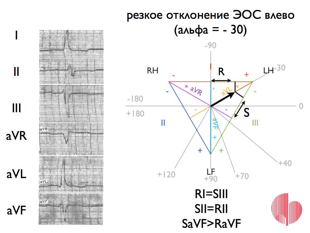 Эос просвет. Резкое отклонение ЭОС влево что это. Электрическая ось сердца собаки. Электрическая ось сердца это тесты. Ось сердца на ЭКГ шпаргалка для СМП.
