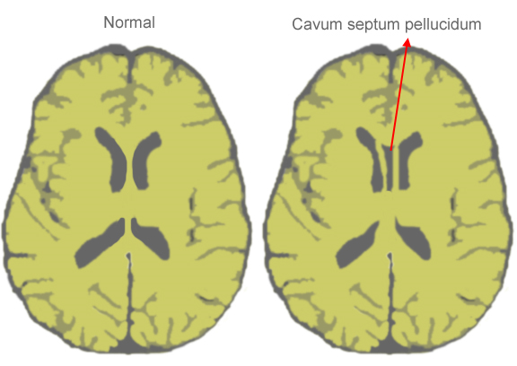 Cavum Septum Pellisidum varlığında her iki beyin lobları arasında iletişimi sağlayan  corpus kallozumun görevi veya fonksiyonu az olacağından , nöral gelişim veya beyin dokusunun azlığıyla giden sıkıntılar görülebilir. gebelik haftası ilerledikçe genellikle kaybolur, kaybolmayıp, boyutunun artması endişe yaratabilir. Doğumdan sonrada kaybolabilmektedir. 

Açıkçası kavum septum pellusidum  persistansı,  corpus kallozum kalitesini düşürmektedir.Yani her 2 beyin hemisferi arasındaki iletişimin kalitesi azalmaktadır.