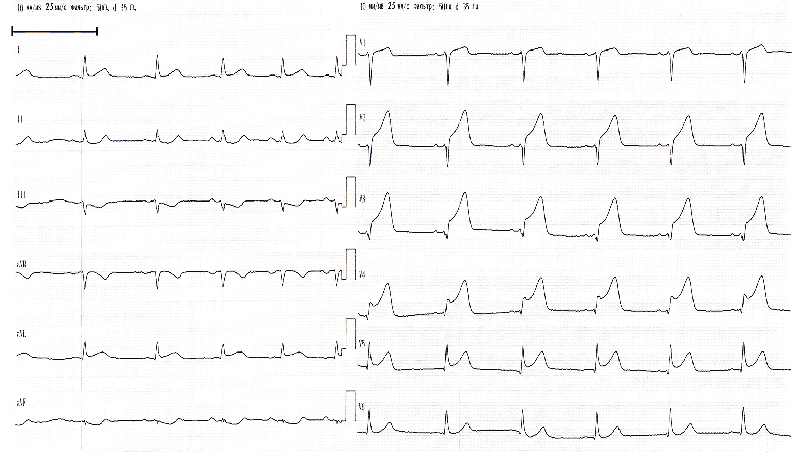 Подъем st v4. Пленка ЭКГ С инфарктом миокарда. ЭКГ динамика инфаркта миокарда. Острый инфаркт миокарда ЭКГ. Стадии ЭКГ при инфаркте миокарда.