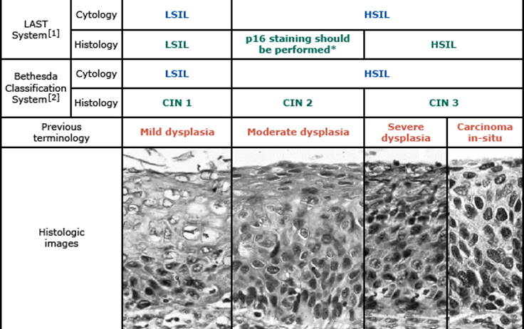 Lsil cin 1. HSIL классификация.