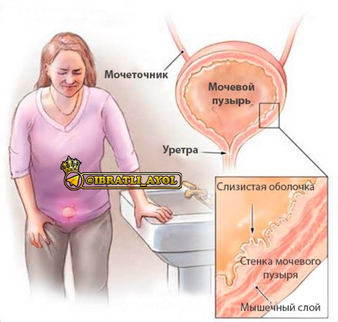 Почему больно писать. Посткоитальный цистит. Цистит у женщин.