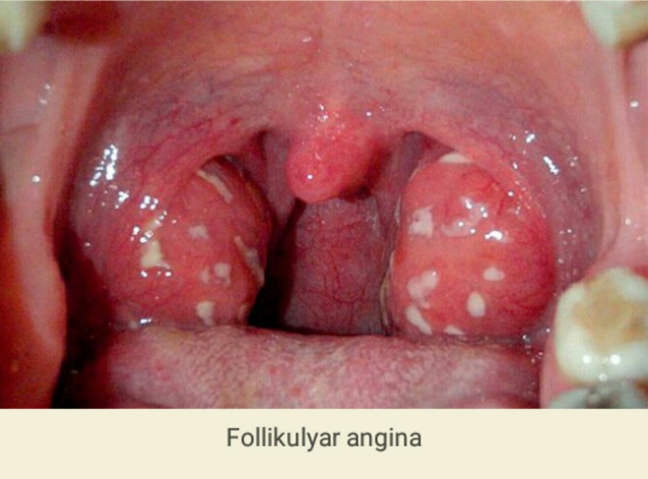 может ли быть ангина после минета фото 102